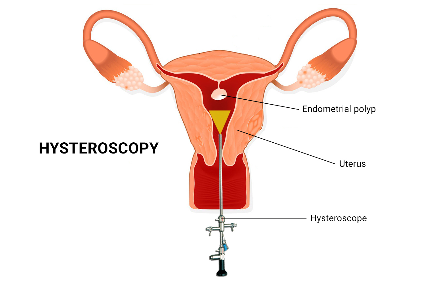 Hysteroscopy